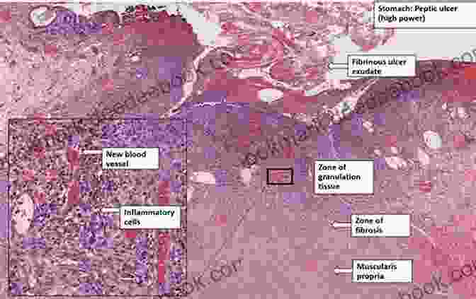 Microscopic Image Of A GI Biopsy Showing Pathological Changes Color Atlas And Synopsis: Gastrointestinal Pathology