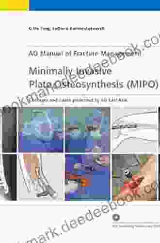 Minimally Invasive Plate Osteosynthesis (MIPO) (AO Publishing)