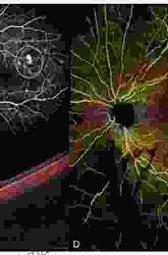 Optical Coherence Tomography Of Ocular Diseases: Third Edition