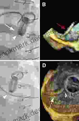 Transcatheter Paravalvular Leak Closure HV Nema